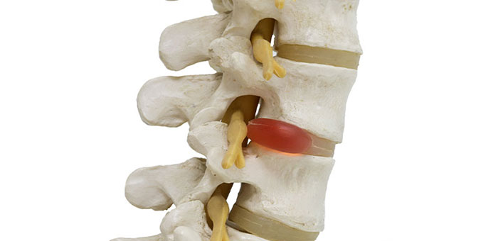 Herniated disc in spine before visiting Lake Worth chiropractor
