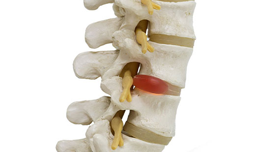 Herniated disc in spine before visiting Lake Worth chiropractor