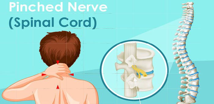 Pinched nerve in spine before chiropractic treatment from Lake Worth chiropractor