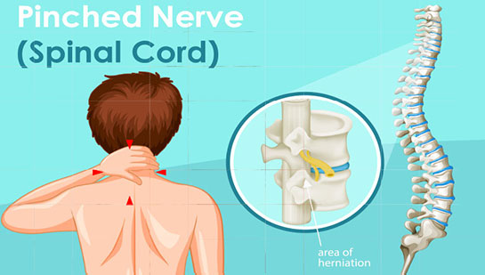 Pinched nerve in spine before chiropractic treatment from Lake Worth chiropractor
