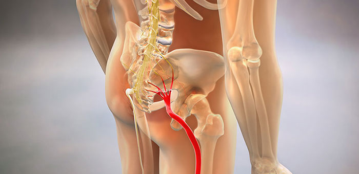 Sciatic nerve pain before chiropractic treatment from Lake Worth chiropractor