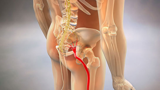 Sciatic nerve pain before chiropractic treatment from Lake Worth chiropractor