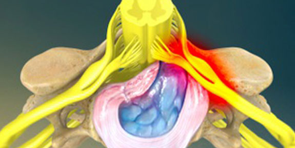 Herniated Disc Lake Worth