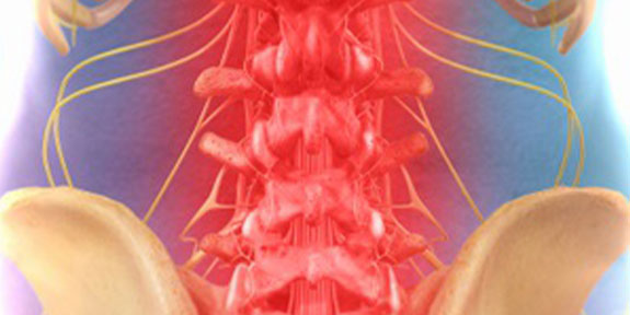 Spinal Decompression Lake Worth