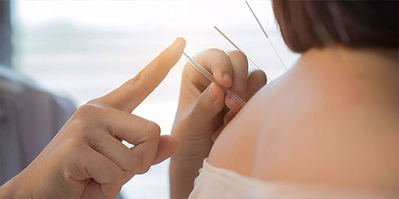 Acupuncture treatment at Center For Auto Accident Injury Treatment in Lake Worth